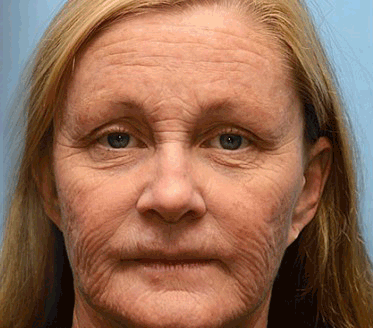 Mubi Botox Bee Venom Rynkefjerning Krem